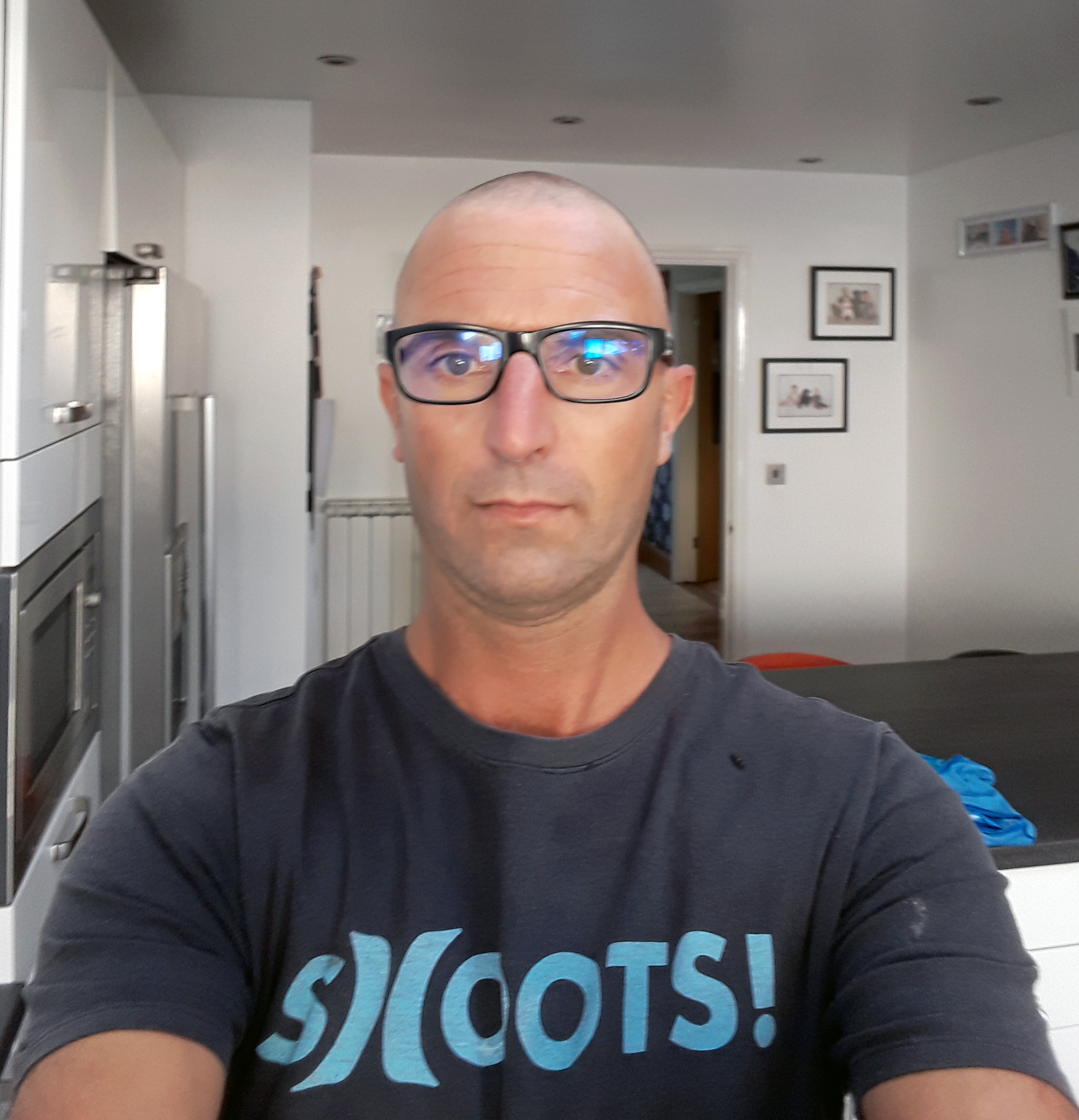 James' chemo-induced hair loss