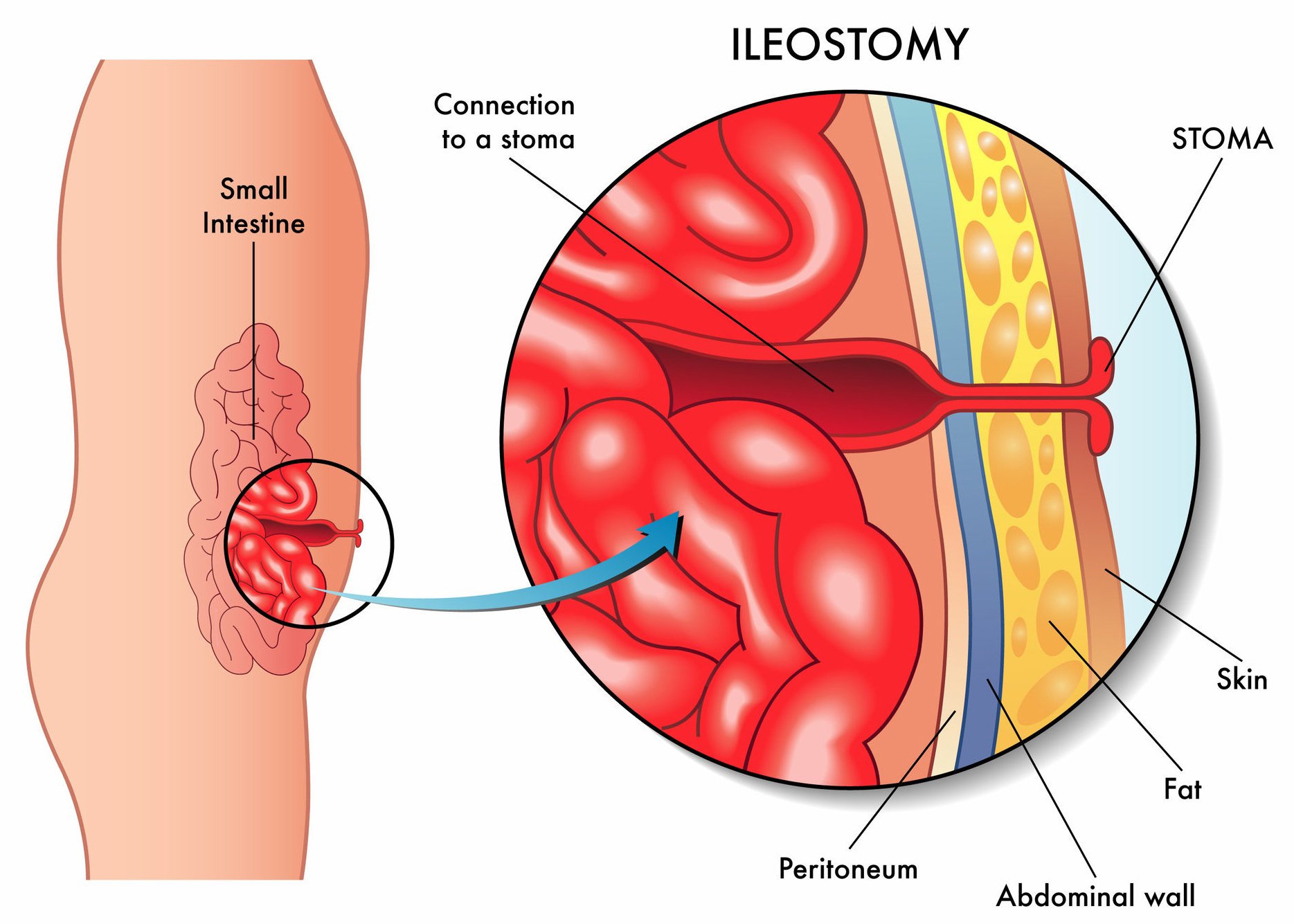 ileostomy from the side