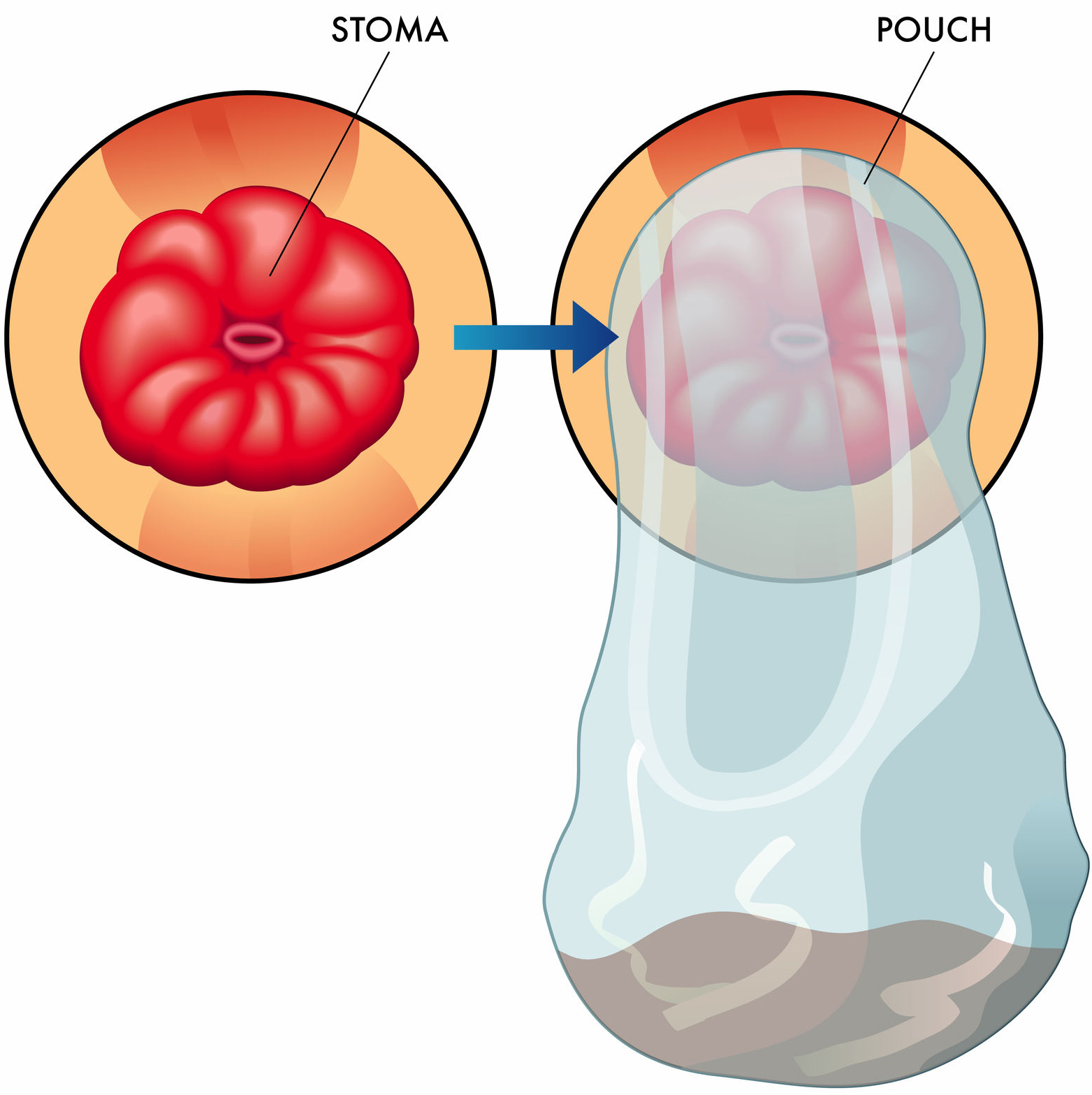 stoma and stoma bag